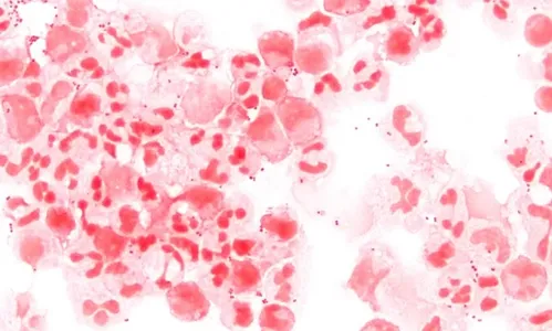 

					Paraíba teve mais de 45 notificações de casos de meningite em 2024

				