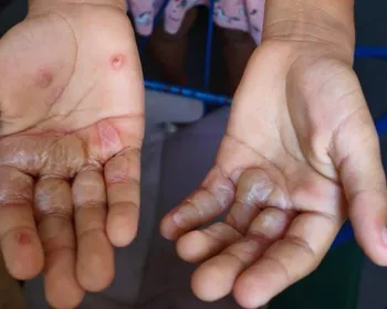 Mãe suspeita de queimar mãos da filha com ovos quentes é solta em João Pessoa