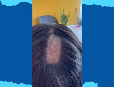 Mulher denuncia ter tido parte da cabeça raspada durante exame toxicológico para CNH em Sapé