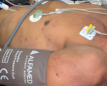 Pessoas são atacadas por abelhas em acampamento e uma sofre mais de 100 picadas, em João Pessoa
