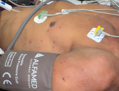 Pessoas são atacadas por abelhas em acampamento e uma sofre mais de 100 picadas, em João Pessoa