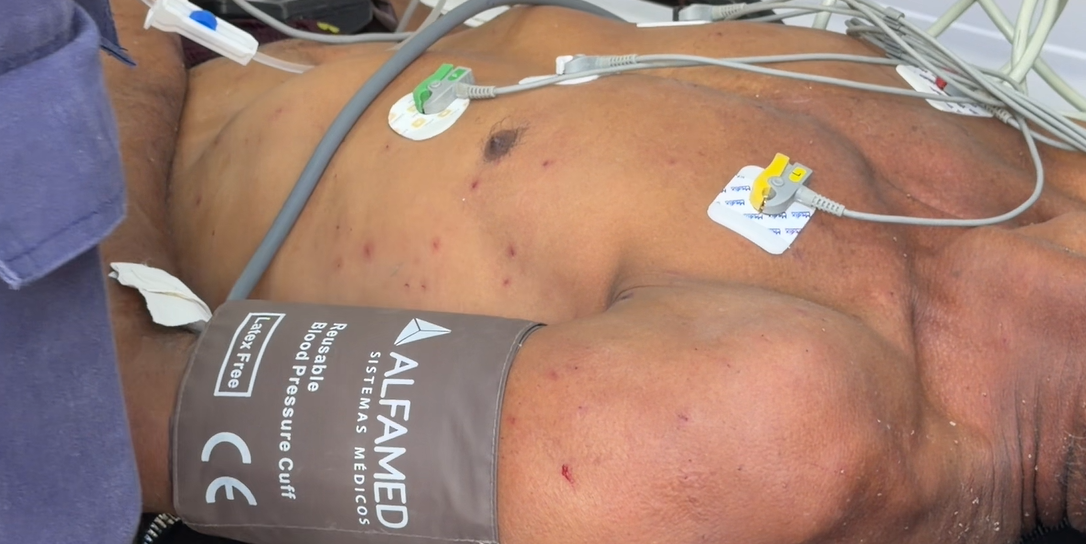Pessoas são atacadas por abelhas em acampamento e uma sofre mais de 100 picadas, em João Pessoa