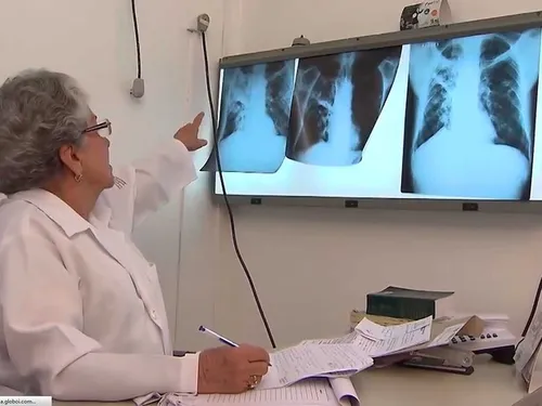 
				
					Paraíba tem mais de 1.100 casos de tuberculose por ano, diz Saúde; conheça sintomas e tratamento
				
				