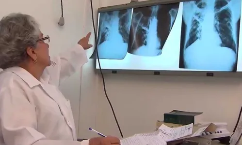 
				
					437 casos de tuberculose já foram diagnosticados em João Pessoa, em 2019
				
				