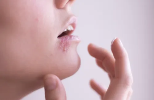 
				
					Herpes labial: atire a primeira pedra quem nunca teve
				
				