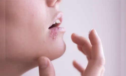 
				
					Herpes labial: atire a primeira pedra quem nunca teve
				
				