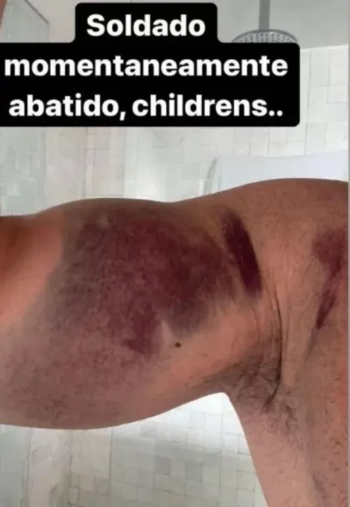 
				
					Deputado estadual Caio Roberto exagera na "malhação" e rompe tendão do peitoral; veja as fotos
				
				