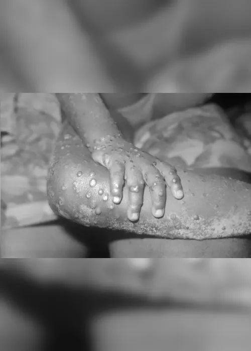 
                                        
                                            Secretaria de Saúde investiga caso suspeito de varíola dos macacos em João Pessoa
                                        
                                        