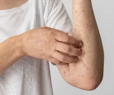 Dermatologista fala sobre os cuidados com as 'doenças de verão'