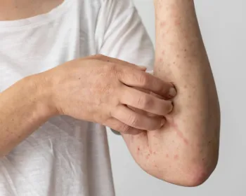 Como acalmar a pele irritada: 5 dicas do que fazer