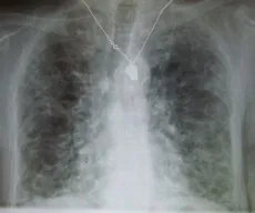 O que é fibrose pulmonar, doença que causou morte de Rita de Cássia