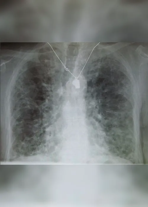 
                                        
                                            O que é fibrose pulmonar, doença que causou morte de Rita de Cássia
                                        
                                        