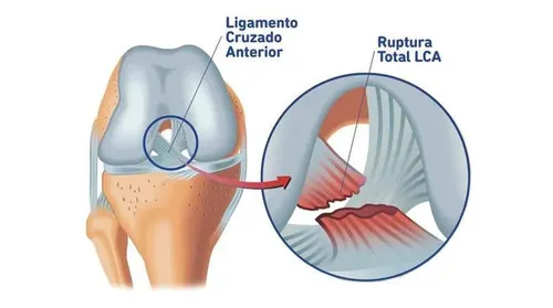 
				
					Lesão de Neymar: entenda o que é rompimento do ligamento cruzado anterior do joelho
				
				