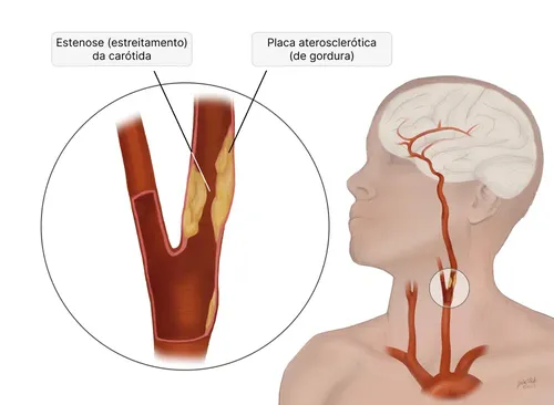 
				
					Plástico pode aumentar risco de infarto e AVC em 5 vezes
				
				